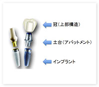 インプラント治療